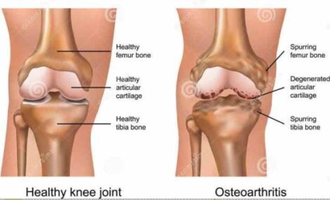 Living with Arthritis: Diminishing the Pain Image
